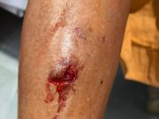 मोकाट कुत्र्यांच्या वाढत्या हल्ल्यांमुळे नागरिकांमध्ये भीतीचे वातावरण – तात्काळ बंदोबस्ताची मागणी